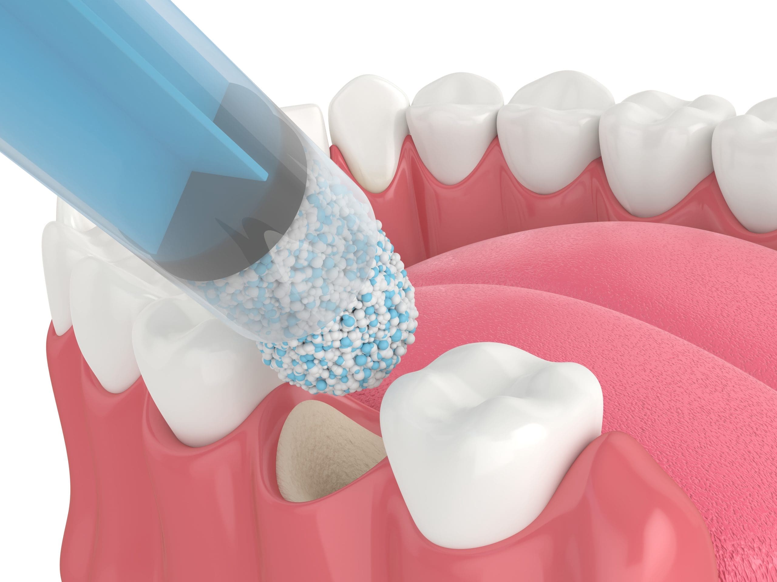 Jefferson Bone Grafting