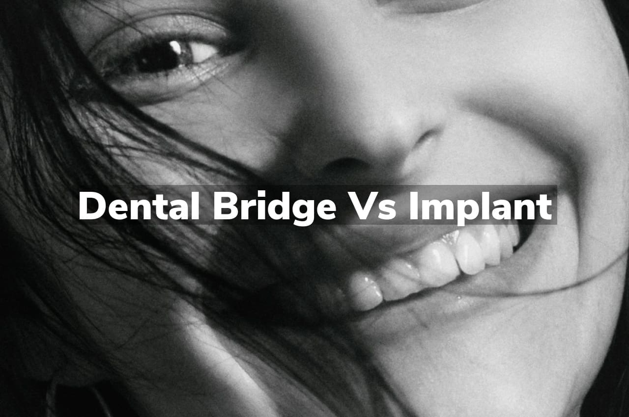 Dental Bridge vs Implant