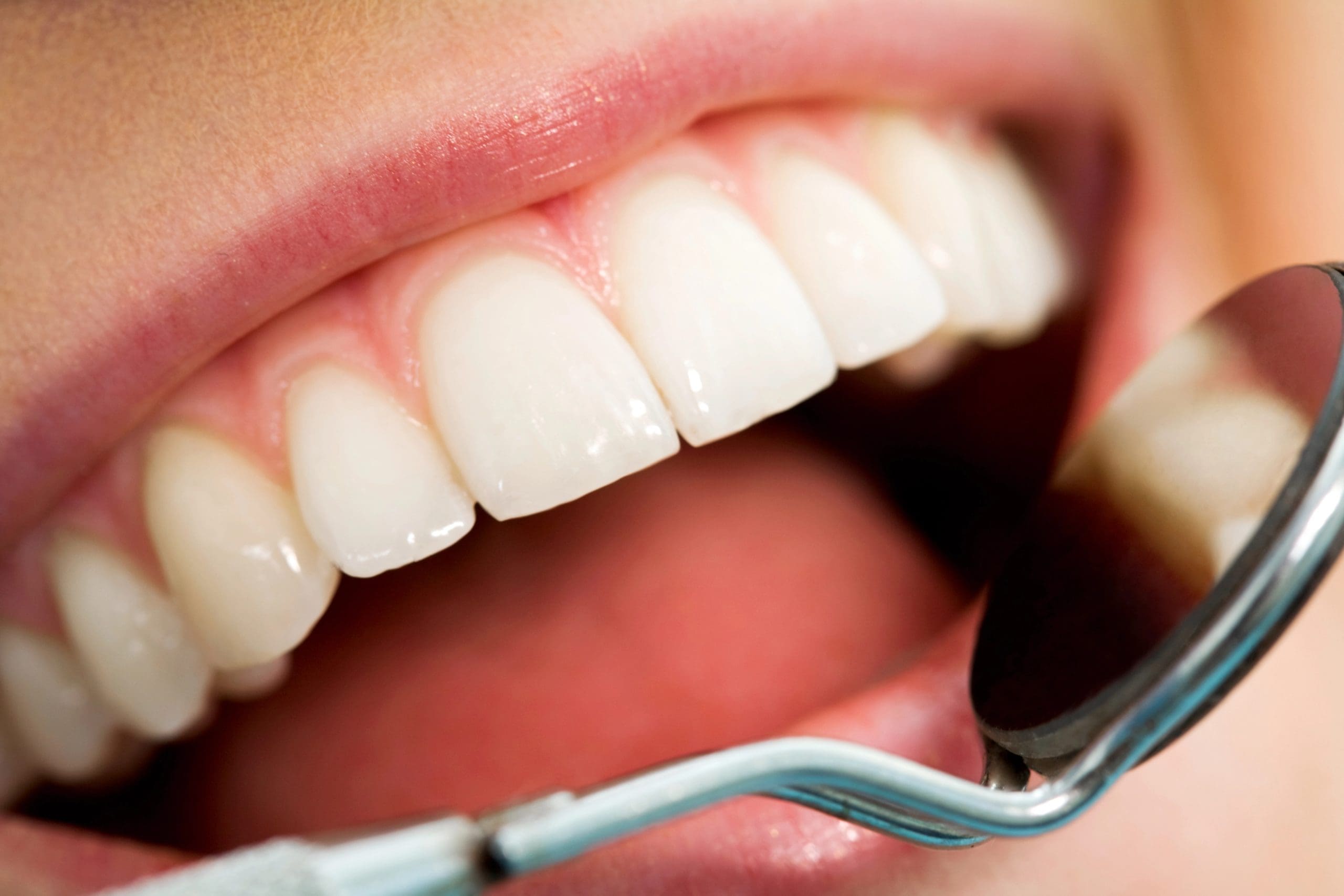 Exploring Types of Fillings in Teeth at Jefferson Dental Clinics