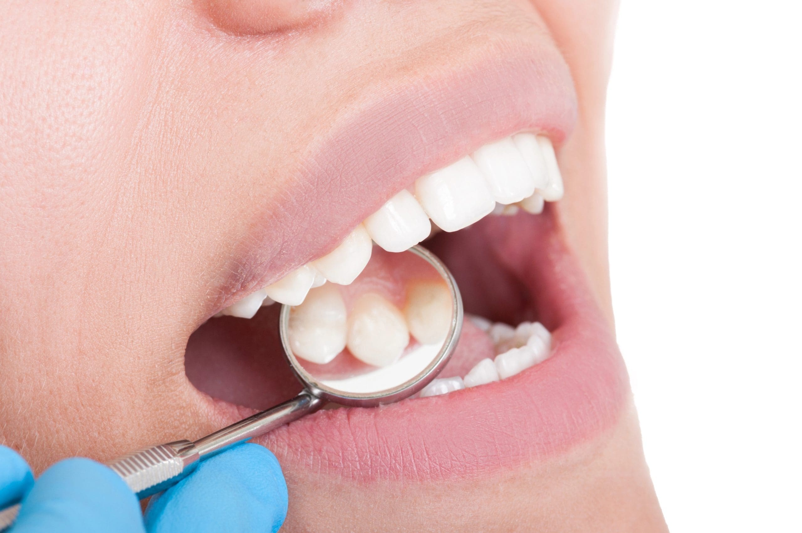 Step-by-Step Procedure for Filling a Cavity in Jefferson